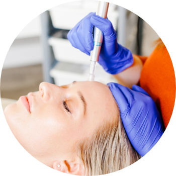a patient having micro-needling treatment at our skin clinic in London